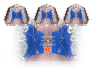 Biobloc is a Palatal Expander without a Bite Plane