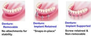 all on 4 vs snap on dentures