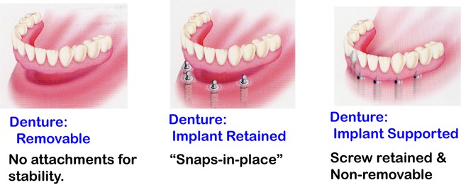 US Dental Overdenture Implant Model - All-on-4 With 4 Screw Upper & Lower Clear Jaw