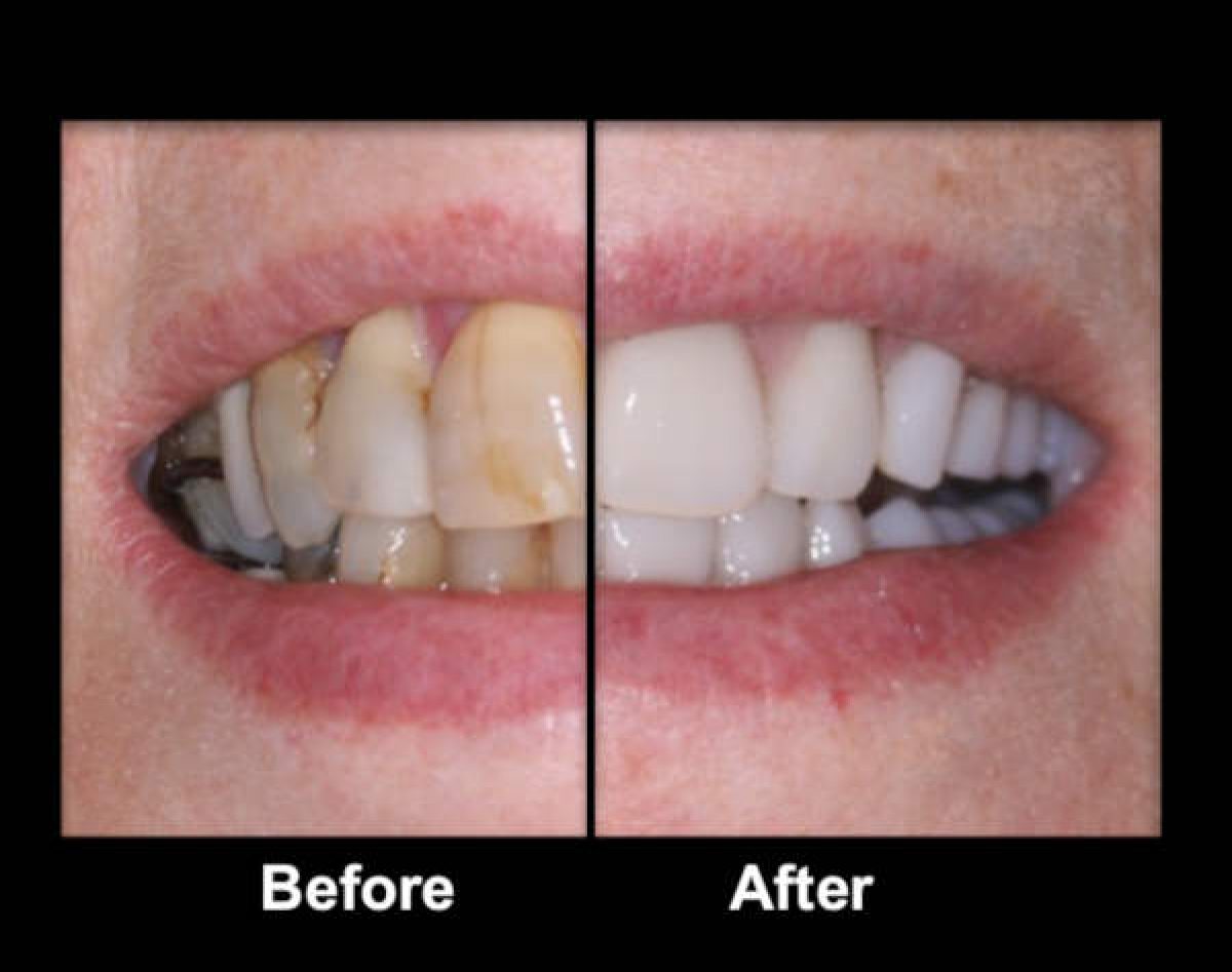 immediate partial dentures