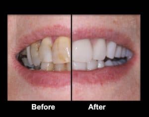 affordable dentures before and after