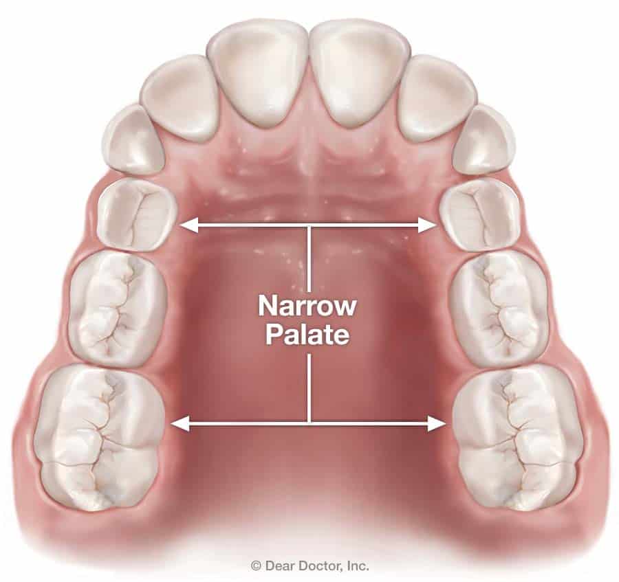 narrow deep palate