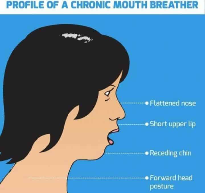 What Causes a Mouth Breather Face?