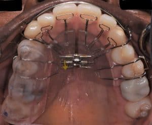 palatal expander