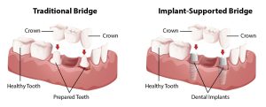 implant bridge and traditional bridge