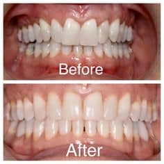 palate expander before and after