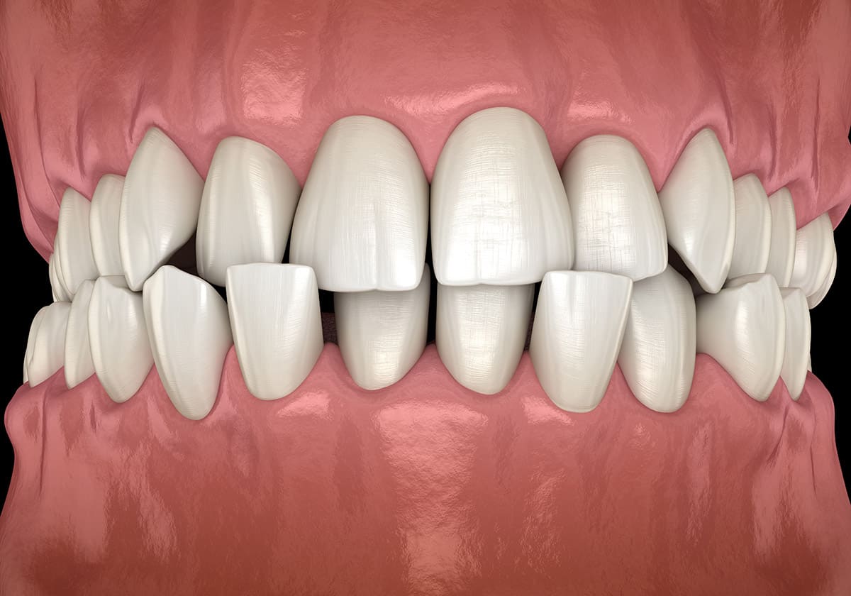 cross bite