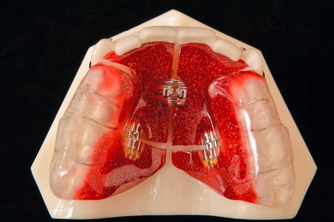 Palatal Expanders-What They Are and How They Work
