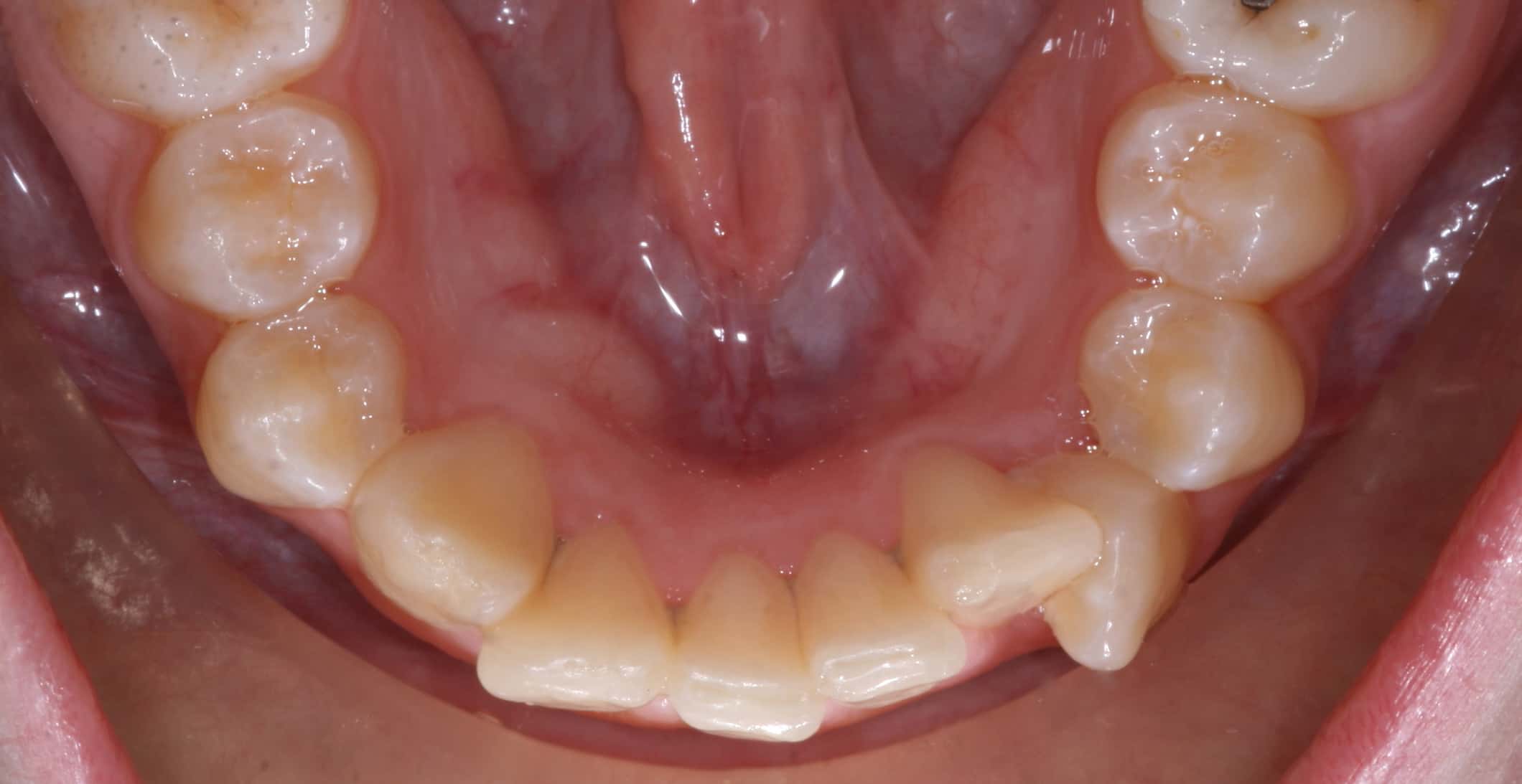teeth crowding