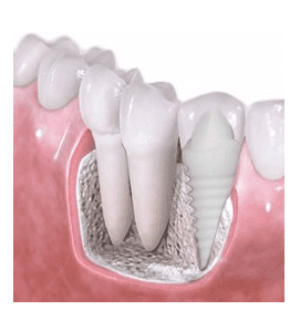 Why not to get Zirconia Implants?