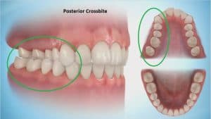 crossbite