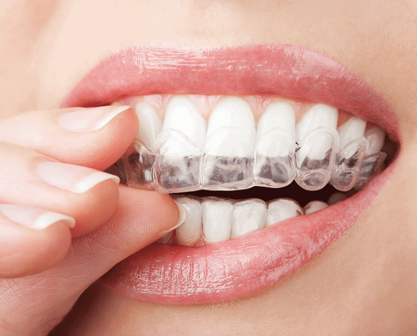 Cost of Invisalign Clear Aligners
