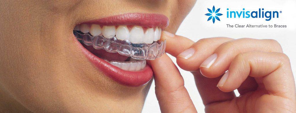 How Invisalign Can Correct Mouth Breathing