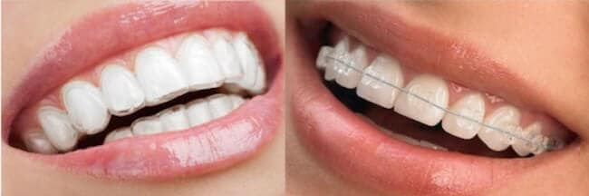 invisalign vs clear braces