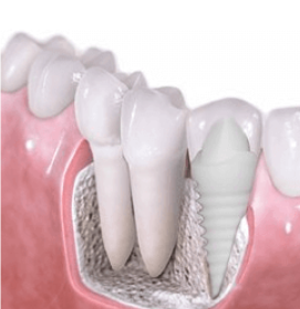 ceramic dental implant