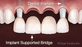 implant bridge