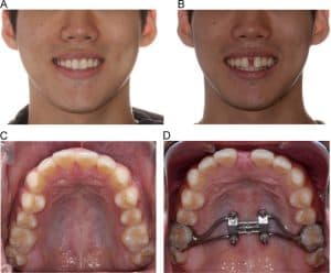 mse maxillary skeletal expander
