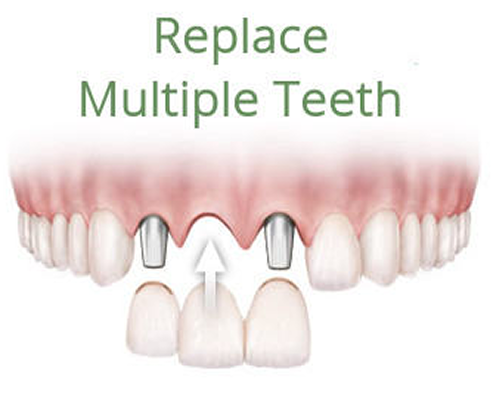 teeth-implant-replacement-1