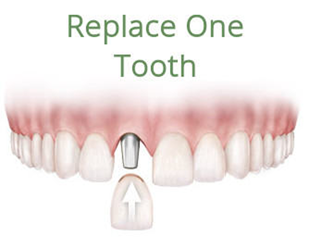 teeth-implant-replacement-2