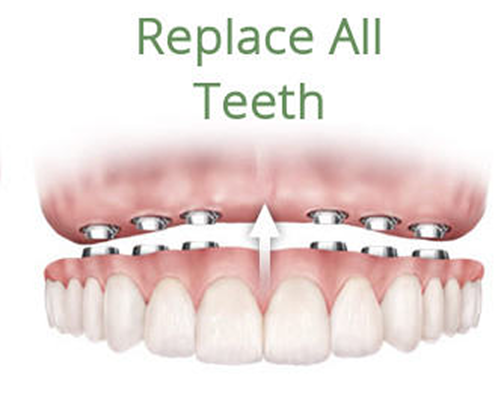 teeth-implant-replacement-3
