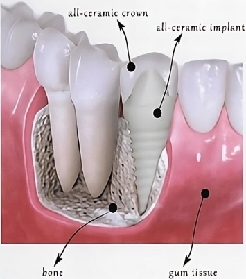 cosmetic implant dentist