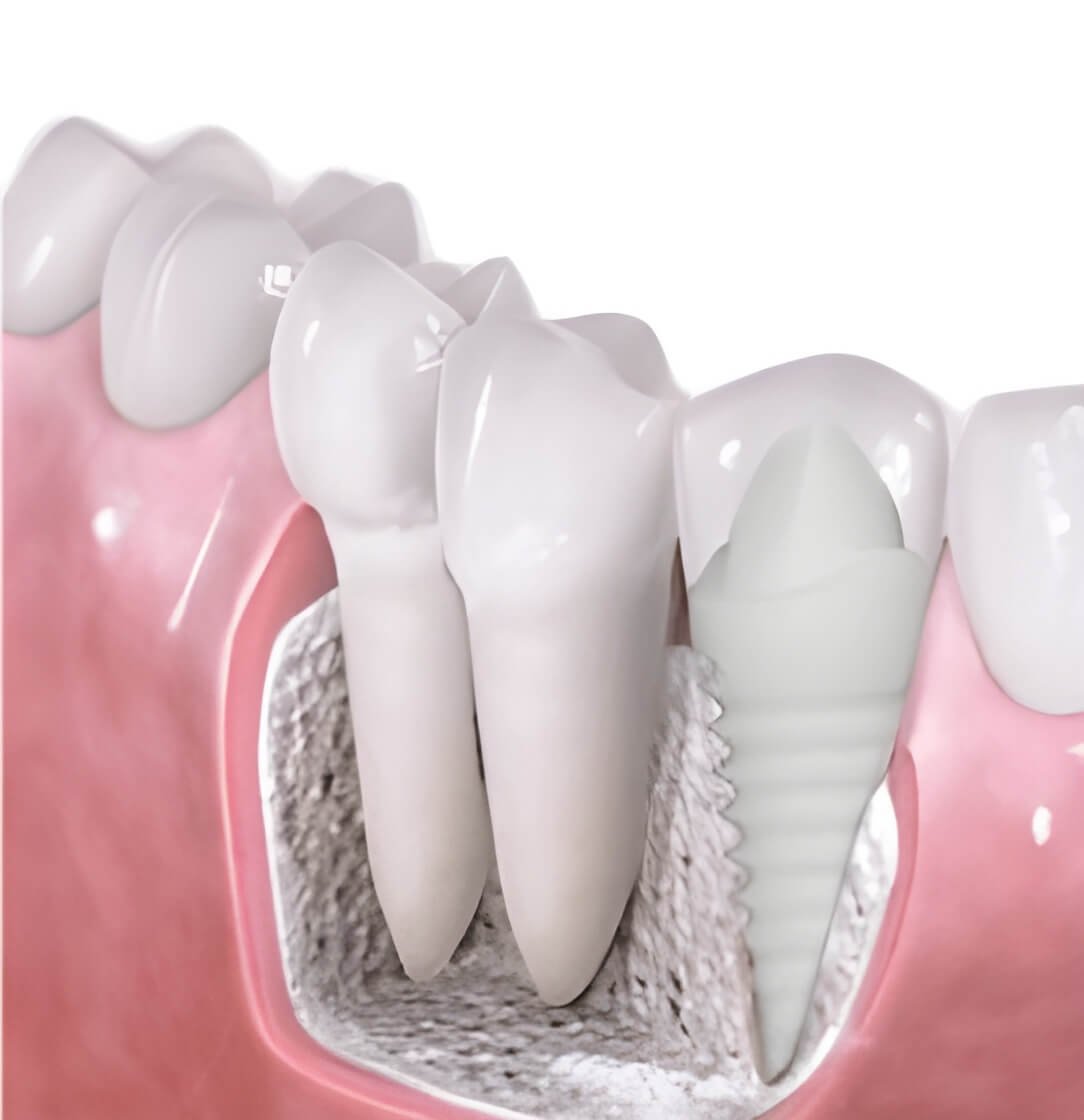 dental implant dentist