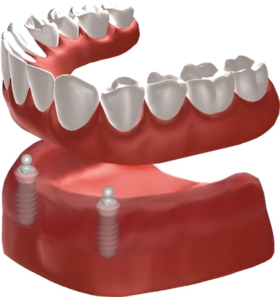 implant denture
