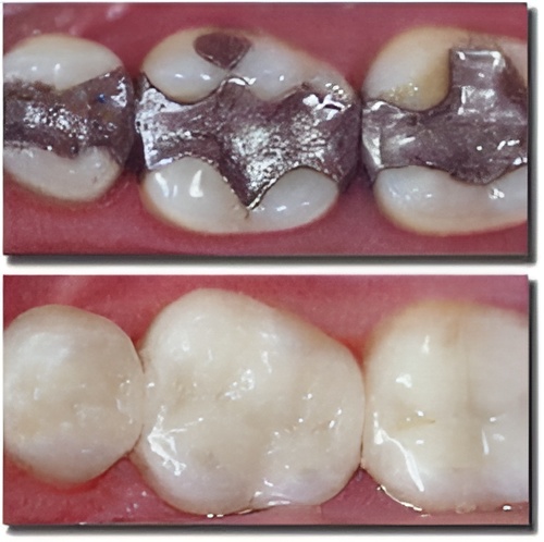 mercury filling removal