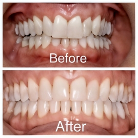 palate expander before and after