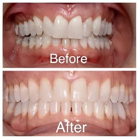 palate expander before and after