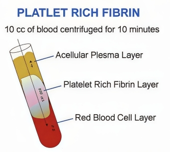 prf platelet rich fibrin