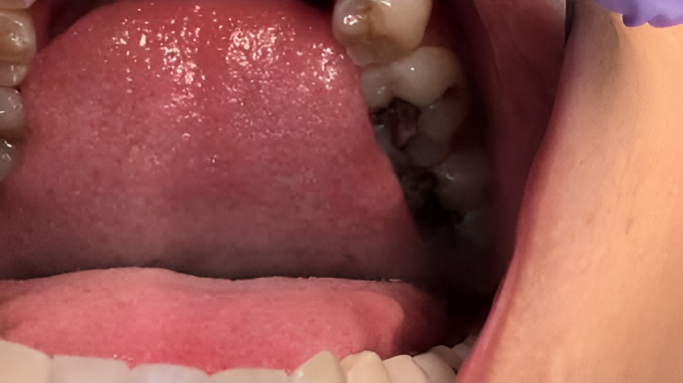 removal of amalgam fillings