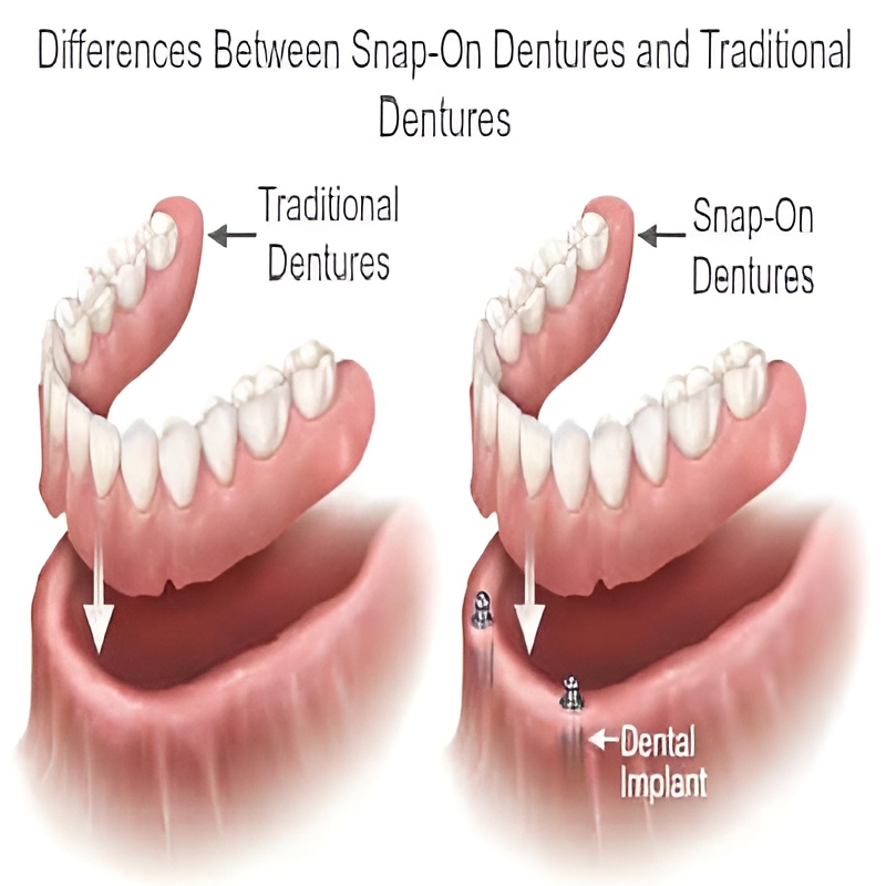snap on dentures vs normal dentures