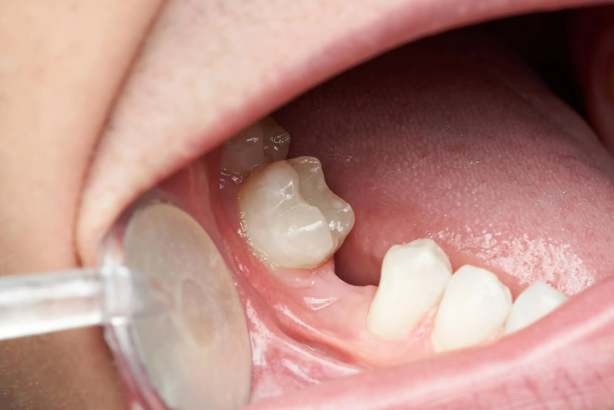 a patient with missing tooth needs to see a holistic dentist burtonsville md_